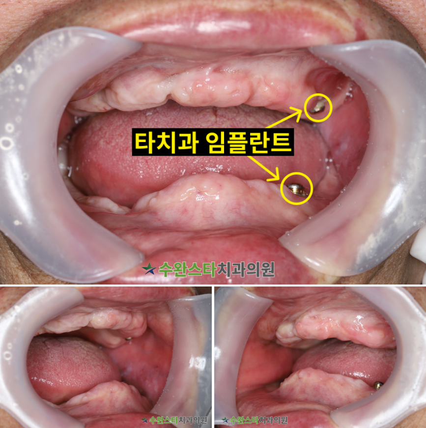처음 내원 시 구강 내부 사진, 70대 남성 (2026.3 촬영)