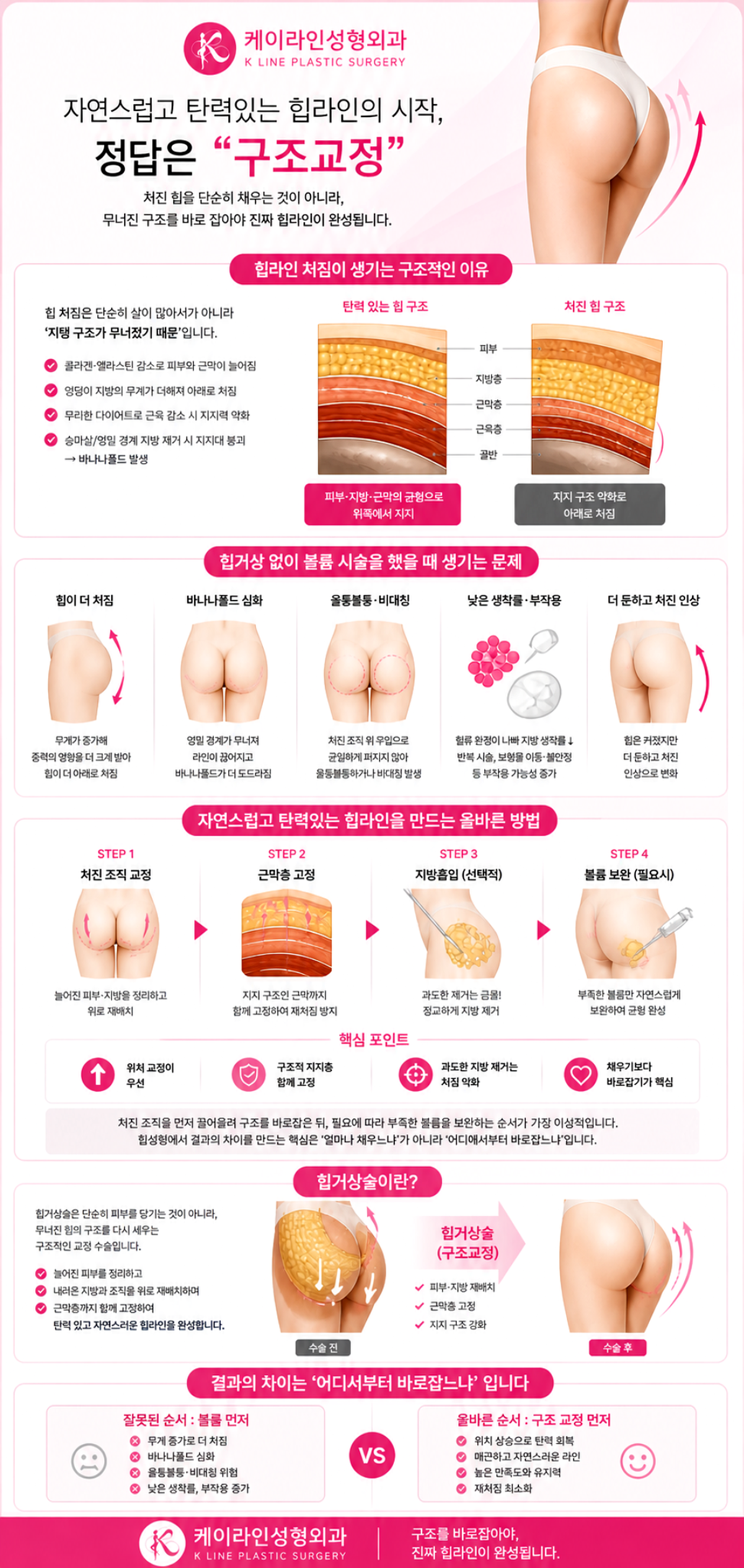힙거상 필요성