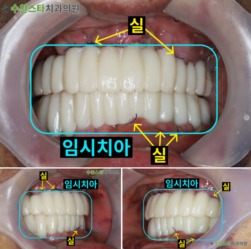 수술 2일 후 임시치아, 70대 남성 (2026.3 촬영)