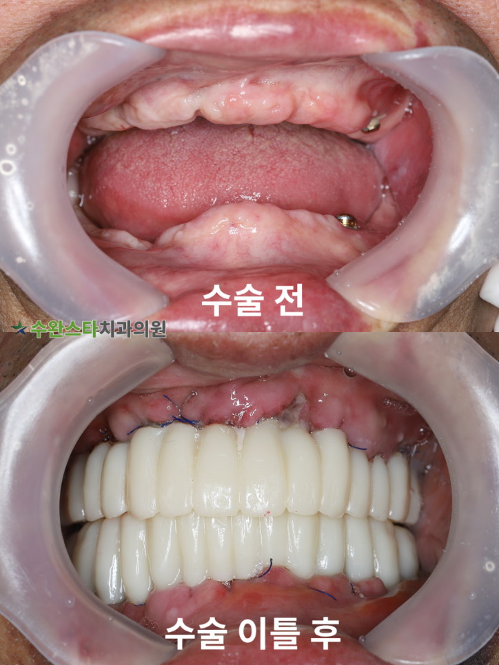 수술 전 / 수술 후 2일 구강 내부, 70대 남성 (2026.3 촬영)  ​