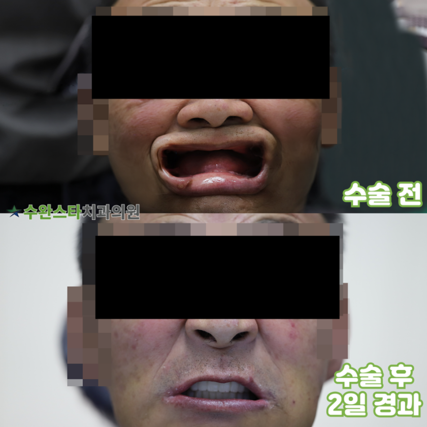 수술 전 / 수술 후 2일 경과, 70대 남성 (2026.3 촬영)  ​
