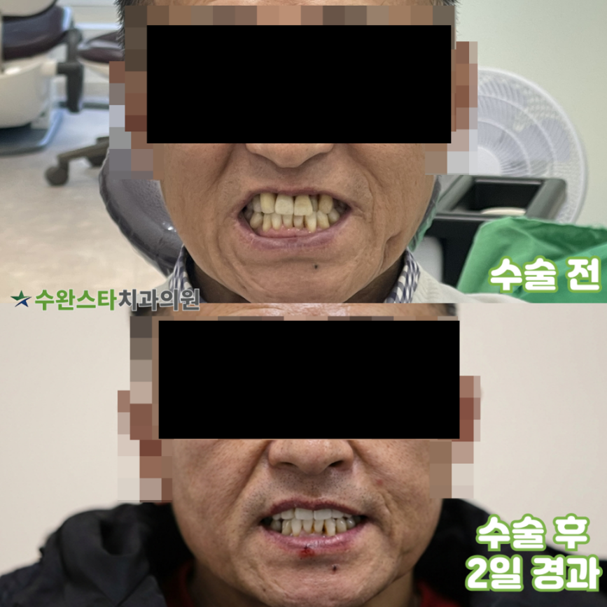 수술 전 / 수술 후 2일 경과, 50대 남성 (2026. 3 촬영)