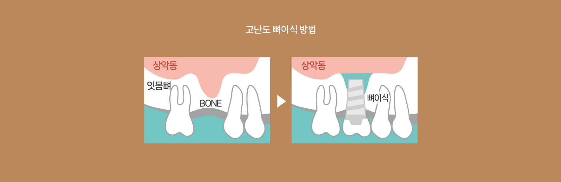 고난도 뼈이식 방법
