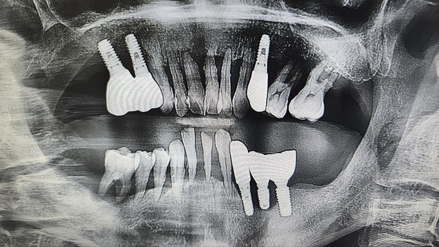 x-ray