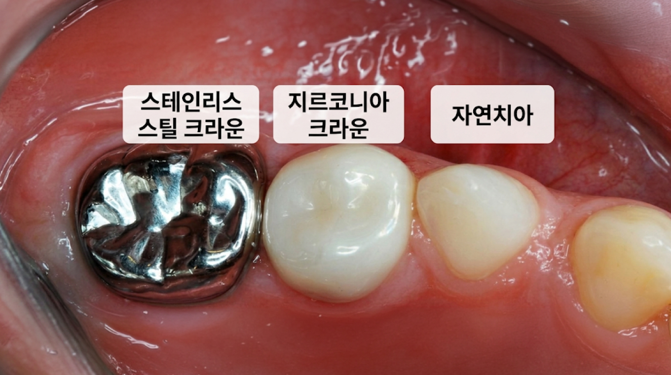 당일 소아 전용 기성 크라운 치료 - 송도 디어스마일치과교정과의원