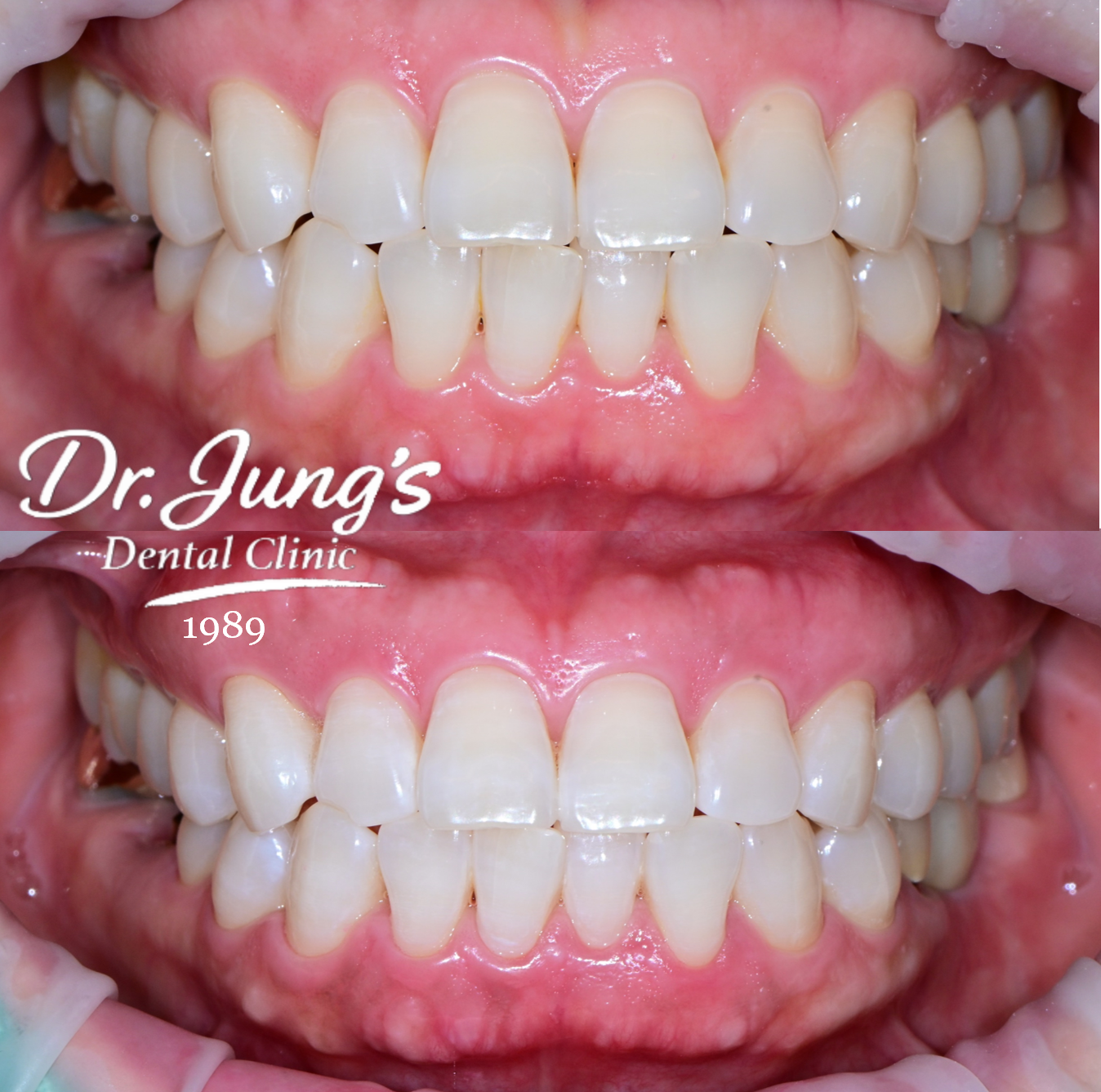 Whitening result Dr. Jung's