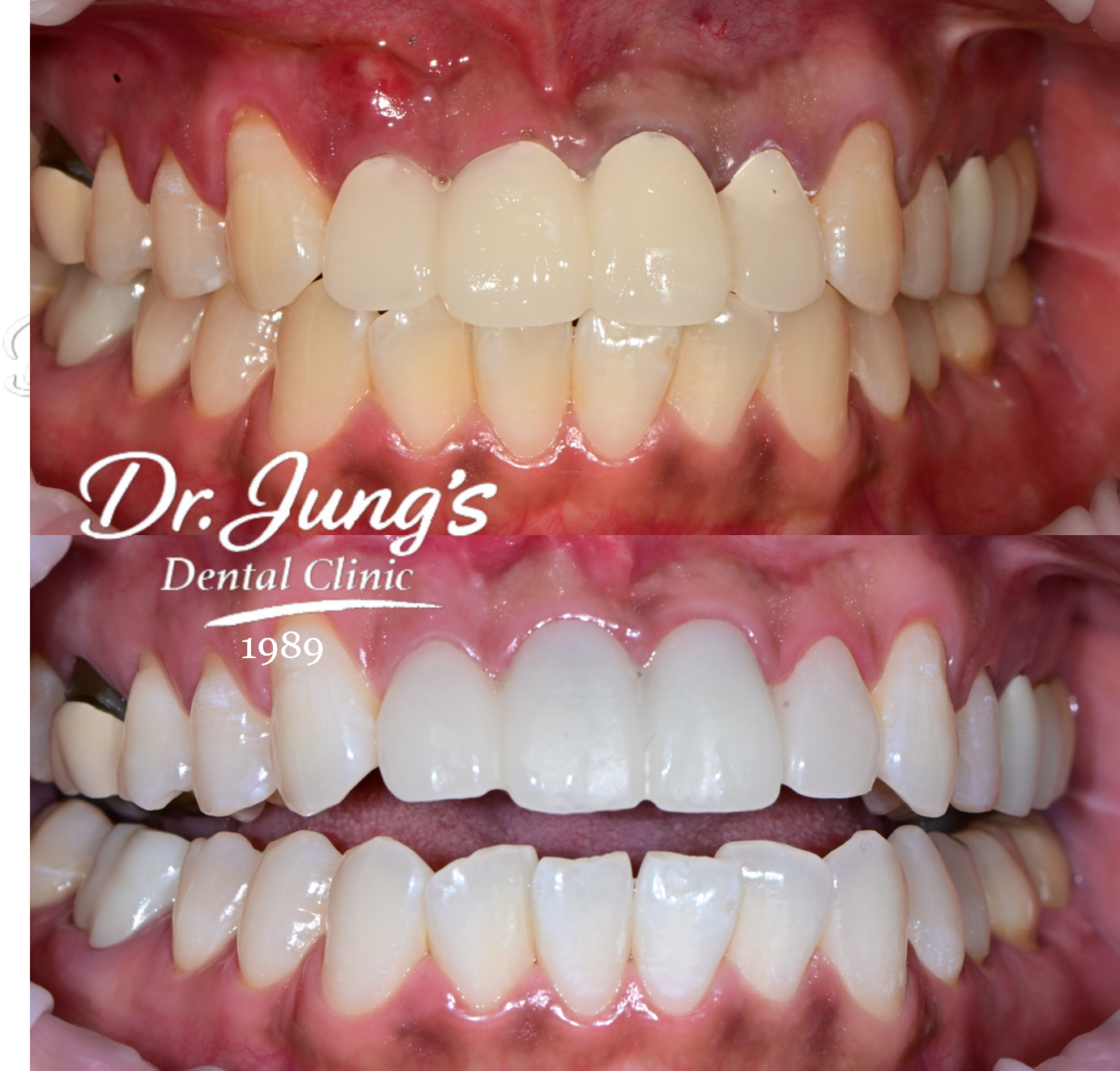 Bleach shade Dr. Jung's