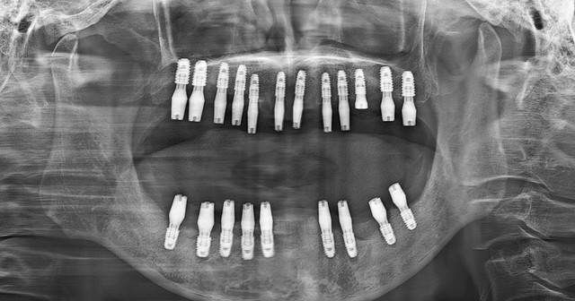 implant