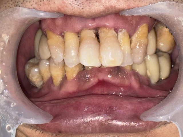 implant