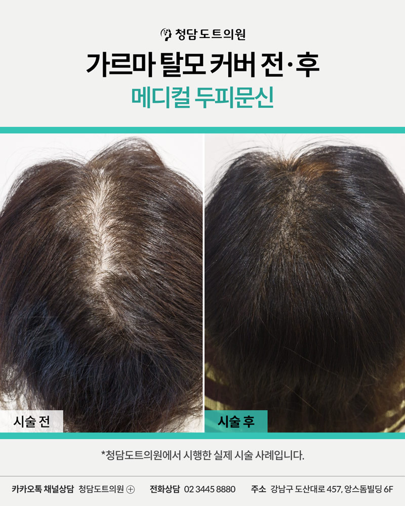 청담도트의원 두피문신 가르마 탈모 커버 전후