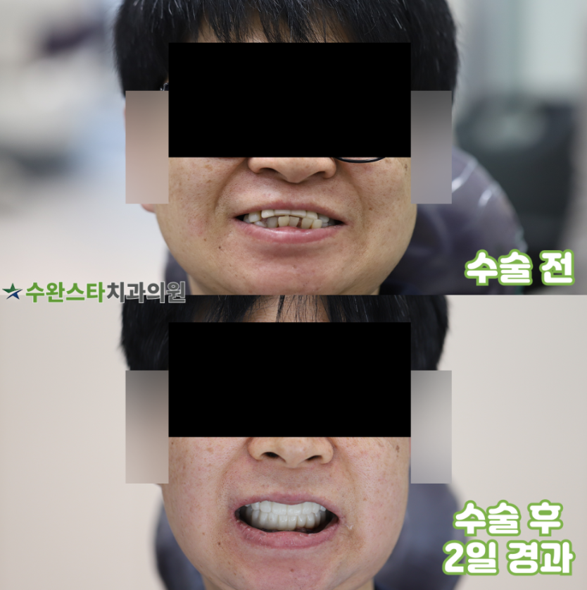 수술 전 / 수술 후 2일 경과, 50대 여성 ( 2026. 4 촬영)