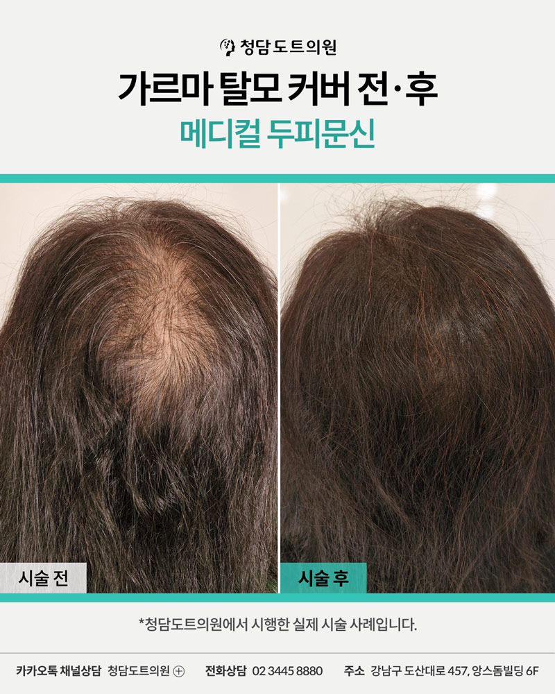 청담도트의원 두피문신 가르마 탈모 커버 전후