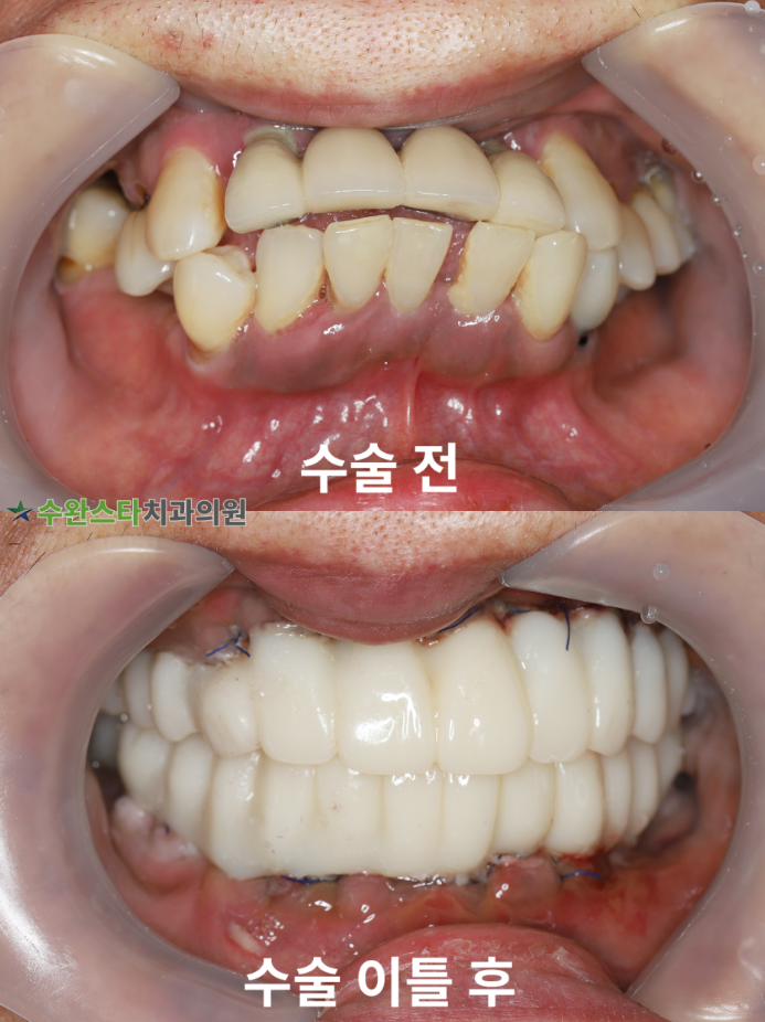 수술 전 / 수술 후 2일 구강 내부, 50대 여성 (2026. 4 촬영)