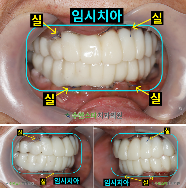 수술 2일 후 임시치아, 50대 여성 (2026. 4 촬영)