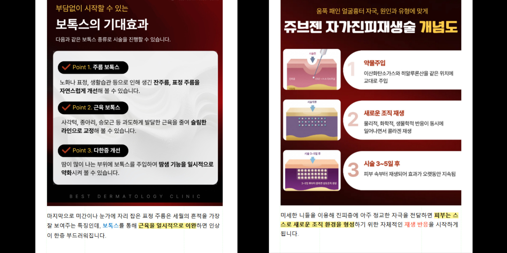 피부과 병원블로그 콘텐츠 제작 포트폴리오 - 실제 보톡스와 쥬브젠 시술 정보 포스팅 사례를 통해 마케팅티처의 병원마케팅 의료 콘텐츠 제작 역량을 보여주는 이미지