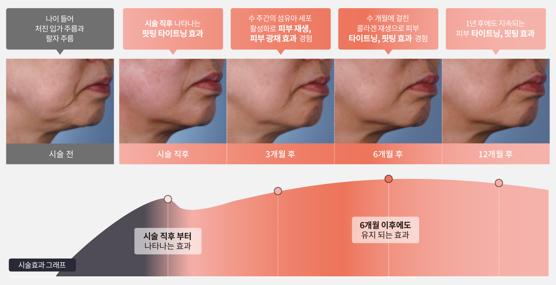 세르프 오래 유지되는 시술효과
