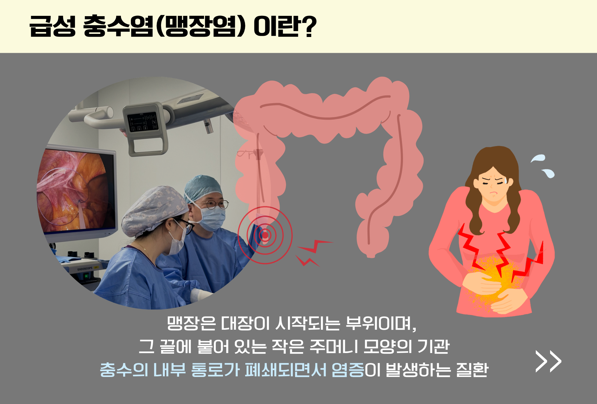 맹장염은 정확히는 “충수염”이라고 부르며,   대장 시작 부위에 붙어 있는   가느다란 장기인 충수돌기에 염증이 생긴 상태를   말합니다.  ​  초기에는 단순한 염증으로 시작되지만   시간이 지나면 충수가 붓고 고름이 차며,   심한 경우 터지면서 복막염으로  진행할 수 있습니다