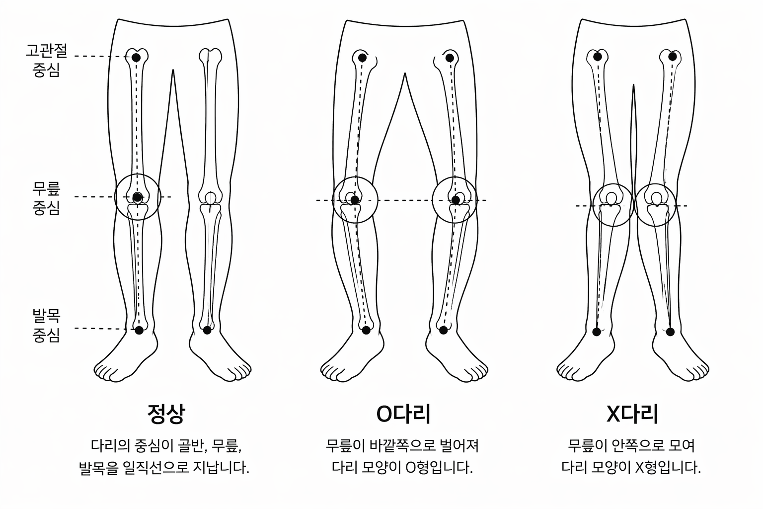 O X 다리 형태