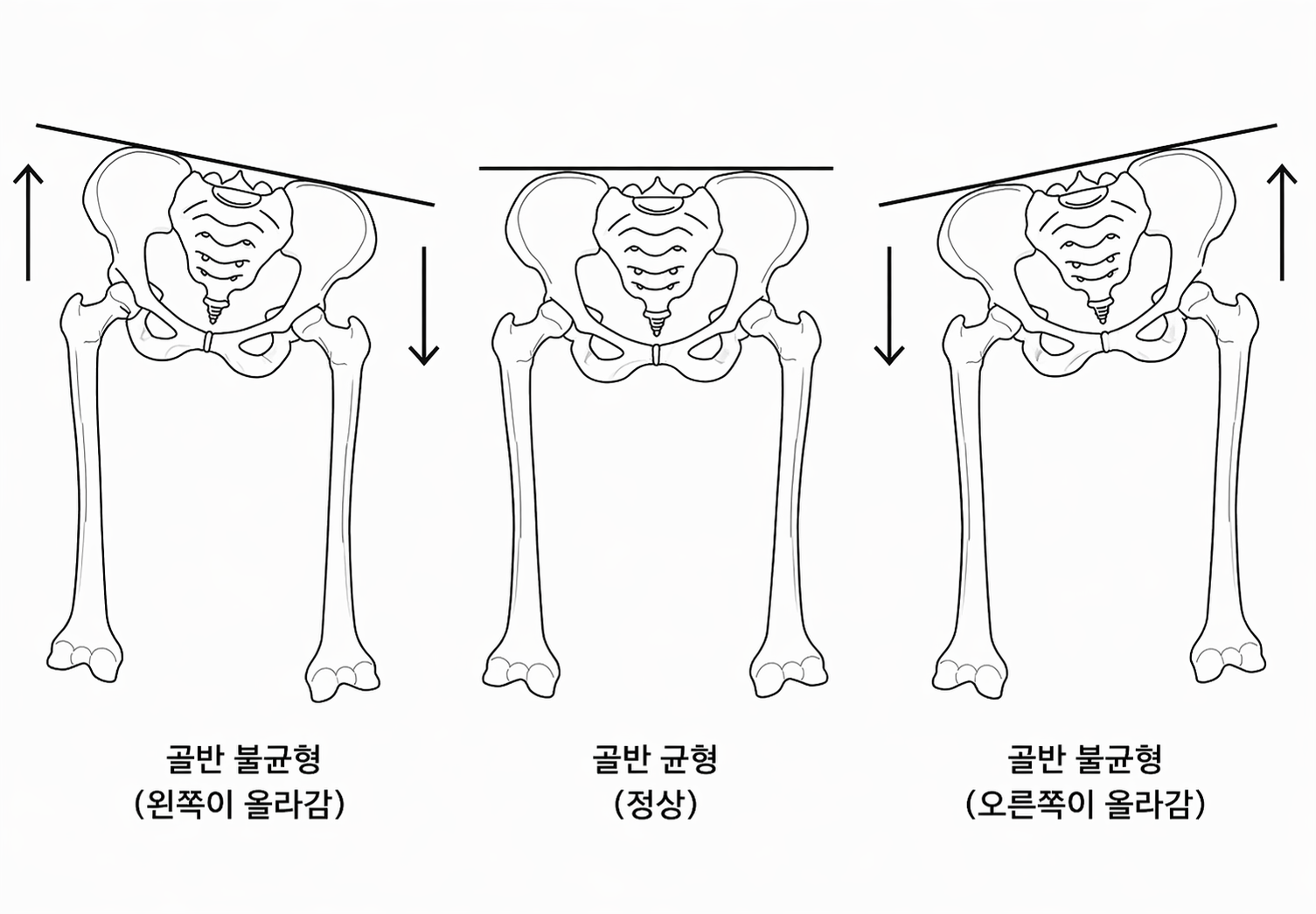 골반 균형