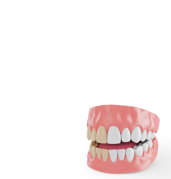 <div class="implant-pc-card-v4">   <div class="implant-pc-head-v4">     <div class="implant-pc-title-v4">심미치료</div>     <p class="implant-pc-desc-v4">라미네이트 · 미백 · 올세라믹</p>   </div>    <div class="implant-pc-copy-v4">     <span class="implant-pc-copy-big-v4">티 나지 않게,</span>     <span class="implant-pc-copy-small-v4">더 환하게</span>   </div>    <span class="implant-pc-btn-v4">     <span class="implant-pc-btn-text-v4">자세히 보기</span>   </span> </div>  <style> .implant-pc-card-v4 {   padding: 60px 40px !important;   font-family: 'Pretendard', 'Noto Sans KR', sans-serif !important;   box-sizing: border-box !important; }  /* 상단 영역 */ .implant-pc-head-v4 {   transform: translateY(-10px) !important; }  .implant-pc-title-v4 {   margin: 0 0 12px !important;   font-size: 36px !important;   font-weight: 700 !important;   line-height: 1.1 !important;   letter-spacing: -0.5px !important;   color: #222222 !important; }  .implant-pc-desc-v4 {   margin: 0 0 32px !important;   font-size: 16px !important;   font-weight: 500 !important;   color: #999999 !important; }  /* 중간 카피 */ .implant-pc-copy-v4 {   margin: 0 0 42px !important;   transform: translateY(-12px) !important;   line-height: 1.25 !important;   letter-spacing: -0.3px !important;   color: #444444 !important; }  .implant-pc-copy-big-v4, .implant-pc-copy-small-v4 {   display: block !important;   margin: 0 !important;   font-size: 18px !important;   font-weight: 600 !important;   line-height: 1.25 !important;   color: #444444 !important; }  .implant-pc-copy-big-v4 {   margin-bottom: 4px !important; }  /* 자세히 보기 */ .implant-pc-btn-v4 {   display: inline-flex !important;   align-items: center !important;   justify-content: flex-start !important;   position: relative !important;   transform: translateY(16px) !important;   padding: 0 0 7px 0 !important;   border-bottom: 1px solid #619b34 !important;   color: #619b34 !important;   line-height: 1 !important;   text-decoration: none !important;   background: none !important;   box-shadow: none !important;   outline: none !important;   cursor: default !important;   pointer-events: none !important; }  .implant-pc-btn-text-v4 {   display: block !important;   margin: 0 !important;   padding: 0 !important;   border: 0 !important;   font-size: 17px !important;   font-weight: 600 !important;   line-height: 1 !important;   letter-spacing: -0.2px !important;   color: #619b34 !important; } </style>