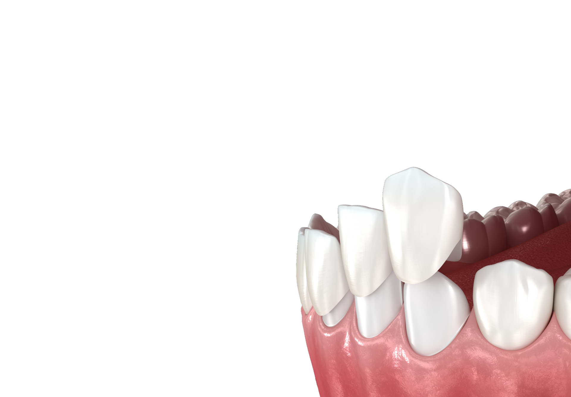 <div class="implant-m-card-v4">   <div class="implant-m-head-v4">     <div class="implant-m-title-v4">미니쉬</div>     <p class="implant-m-desc-v4">초박형 라미네이트</p>   </div>    <div class="implant-m-copy-v4">     <span class="implant-m-copy-big-v4">남기고 싶은 치아는,</span>     <span class="implant-m-copy-small-v4">남깁니다</span>   </div>    <span class="implant-m-more-v4">     <span class="implant-m-more-text-v4">자세히 보기</span>   </span> </div>  <style> .implant-m-card-v4 {   display: block !important;   width: 100% !important;   padding: 19px 16px 24px 10px !important;   margin: 0 !important;   font-family: 'Pretendard', 'Noto Sans KR', sans-serif !important;   box-sizing: border-box !important;   position: relative !important;   z-index: 10 !important; }  .implant-m-head-v4 {   transform: translateY(-4px) !important; }  .implant-m-title-v4 {   display: block !important;   margin: 0 0 8px 0 !important;   padding: 0 !important;   font-size: 24px !important;   font-weight: 700 !important;   line-height: 1.08 !important;   letter-spacing: -0.5px !important;   color: #222222 !important; }  .implant-m-desc-v4 {   display: block !important;   margin: 0 0 16px 0 !important;   padding: 0 !important;   font-size: 14px !important;   font-weight: 500 !important;   line-height: 1.3 !important;   color: #999999 !important; }  .implant-m-copy-v4 {   display: block !important;   margin: 0 0 20px 0 !important;   padding: 0 !important;   transform: translateY(-7px) !important;   line-height: 1.25 !important;   letter-spacing: -0.3px !important;   color: #444444 !important; }  .implant-m-copy-big-v4, .implant-m-copy-small-v4 {   display: block !important;   margin: 0 !important;   padding: 0 !important;   font-size: 15px !important;   font-weight: 600 !important;   line-height: 1.25 !important;   color: #444444 !important; }  .implant-m-copy-big-v4 {   margin-bottom: 3px !important; }  .implant-m-more-v4 {   display: inline-flex !important;   align-items: center !important;   justify-content: flex-start !important;   transform: translateY(4px) !important;   padding: 0 0 5px 0 !important;   margin: 0 !important;   border-bottom: 1px solid #619b34 !important;   color: #619b34 !important;   line-height: 1 !important;   background: none !important;   text-decoration: none !important;   box-shadow: none !important;   outline: none !important;   cursor: default !important;   pointer-events: none !important; }  .implant-m-more-text-v4 {   display: block !important;   margin: 0 !important;   padding: 0 !important;   border: 0 !important;   font-size: 14px !important;   font-weight: 600 !important;   line-height: 1 !important;   letter-spacing: -0.2px !important;   color: #619b34 !important; } </style>