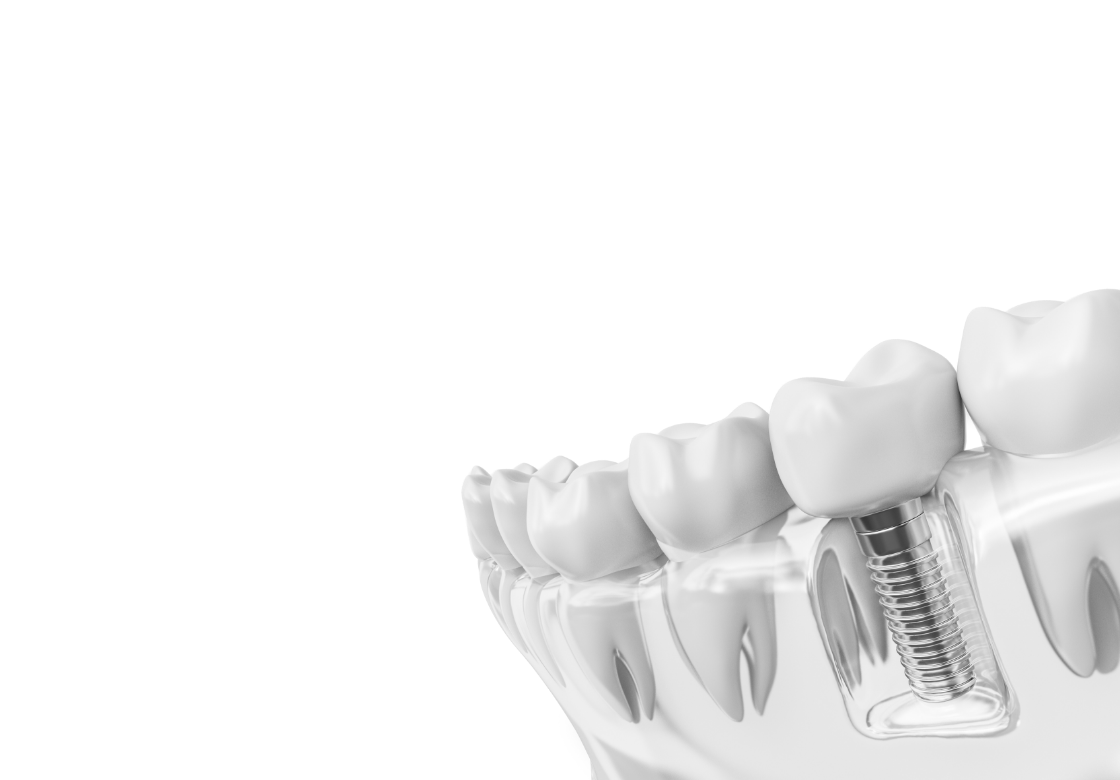 <div class="implant-pc-card-v4">   <div class="implant-pc-head-v4">     <div class="implant-pc-title-v4">임플란트</div>     <p class="implant-pc-desc-v4">전악 · 부분 · 뼈이식 · 틀니</p>   </div>    <div class="implant-pc-copy-v4">     <span class="implant-pc-copy-big-v4">다시 마음껏</span>     <span class="implant-pc-copy-small-v4">드실 수 있도록</span>   </div>    <span class="implant-pc-btn-v4">     <span class="implant-pc-btn-text-v4">자세히 보기</span>   </span> </div>  <style> .implant-pc-card-v4 {   padding: 60px 40px !important;   font-family: 'Pretendard', 'Noto Sans KR', sans-serif !important;   box-sizing: border-box !important; }  /* 상단 영역 */ .implant-pc-head-v4 {   transform: translateY(-10px) !important; }  .implant-pc-title-v4 {   margin: 0 0 12px !important;   font-size: 36px !important;   font-weight: 700 !important;   line-height: 1.1 !important;   letter-spacing: -0.5px !important;   color: #222222 !important; }  .implant-pc-desc-v4 {   margin: 0 0 32px !important;   font-size: 16px !important;   font-weight: 500 !important;   color: #999999 !important; }  /* 중간 카피 */ .implant-pc-copy-v4 {   margin: 0 0 42px !important;   transform: translateY(-12px) !important;   line-height: 1.25 !important;   letter-spacing: -0.3px !important;   color: #444444 !important; }  .implant-pc-copy-big-v4, .implant-pc-copy-small-v4 {   display: block !important;   margin: 0 !important;   font-size: 18px !important;   font-weight: 600 !important;   line-height: 1.25 !important;   color: #444444 !important; }  .implant-pc-copy-big-v4 {   margin-bottom: 4px !important; }  /* 자세히 보기 */ .implant-pc-btn-v4 {   display: inline-flex !important;   align-items: center !important;   justify-content: flex-start !important;   position: relative !important;   transform: translateY(16px) !important;   padding: 0 0 7px 0 !important;   border-bottom: 1px solid #619b34 !important;   color: #619b34 !important;   line-height: 1 !important;   text-decoration: none !important;   background: none !important;   box-shadow: none !important;   outline: none !important;   cursor: default !important;   pointer-events: none !important; }  .implant-pc-btn-text-v4 {   display: block !important;   margin: 0 !important;   padding: 0 !important;   border: 0 !important;   font-size: 17px !important;   font-weight: 600 !important;   line-height: 1 !important;   letter-spacing: -0.2px !important;   color: #619b34 !important; } </style>