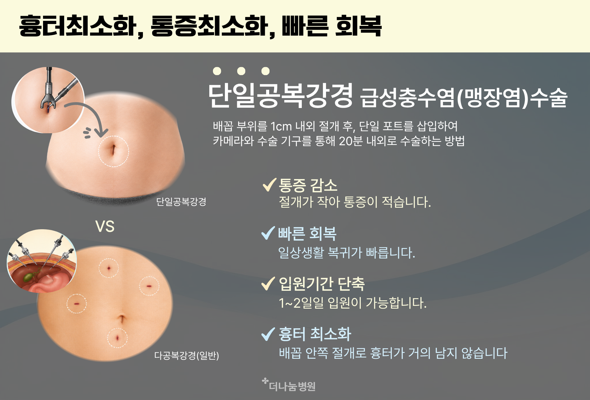 단일공복강경 맹장수술의 장점. 흉터최소화 통증최소화 빠른회복