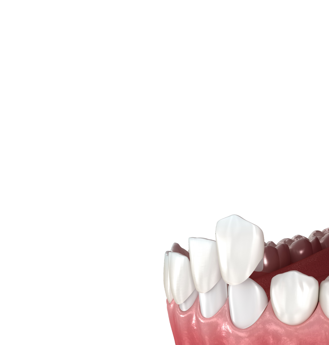 <div class="implant-pc-card-v4">   <div class="implant-pc-head-v4">     <div class="implant-pc-title-v4">미니쉬</div>     <p class="implant-pc-desc-v4">초박형 라미네이트</p>   </div>    <div class="implant-pc-copy-v4">     <span class="implant-pc-copy-big-v4">남기고 싶은 치아는,</span>     <span class="implant-pc-copy-small-v4">남깁니다</span>   </div>    <span class="implant-pc-btn-v4">     <span class="implant-pc-btn-text-v4">자세히 보기</span>   </span> </div>  <style> .implant-pc-card-v4 {   padding: 60px 40px !important;   font-family: 'Pretendard', 'Noto Sans KR', sans-serif !important;   box-sizing: border-box !important; }  /* 상단 영역 */ .implant-pc-head-v4 {   transform: translateY(-10px) !important; }  .implant-pc-title-v4 {   margin: 0 0 12px !important;   font-size: 36px !important;   font-weight: 700 !important;   line-height: 1.1 !important;   letter-spacing: -0.5px !important;   color: #222222 !important; }  .implant-pc-desc-v4 {   margin: 0 0 32px !important;   font-size: 16px !important;   font-weight: 500 !important;   color: #999999 !important; }  /* 중간 카피 */ .implant-pc-copy-v4 {   margin: 0 0 42px !important;   transform: translateY(-12px) !important;   line-height: 1.25 !important;   letter-spacing: -0.3px !important;   color: #444444 !important; }  .implant-pc-copy-big-v4, .implant-pc-copy-small-v4 {   display: block !important;   margin: 0 !important;   font-size: 18px !important;   font-weight: 600 !important;   line-height: 1.25 !important;   color: #444444 !important; }  .implant-pc-copy-big-v4 {   margin-bottom: 4px !important; }  /* 자세히 보기 */ .implant-pc-btn-v4 {   display: inline-flex !important;   align-items: center !important;   justify-content: flex-start !important;   position: relative !important;   transform: translateY(16px) !important;   padding: 0 0 7px 0 !important;   border-bottom: 1px solid #619b34 !important;   color: #619b34 !important;   line-height: 1 !important;   text-decoration: none !important;   background: none !important;   box-shadow: none !important;   outline: none !important;   cursor: default !important;   pointer-events: none !important; }  .implant-pc-btn-text-v4 {   display: block !important;   margin: 0 !important;   padding: 0 !important;   border: 0 !important;   font-size: 17px !important;   font-weight: 600 !important;   line-height: 1 !important;   letter-spacing: -0.2px !important;   color: #619b34 !important; } </style>