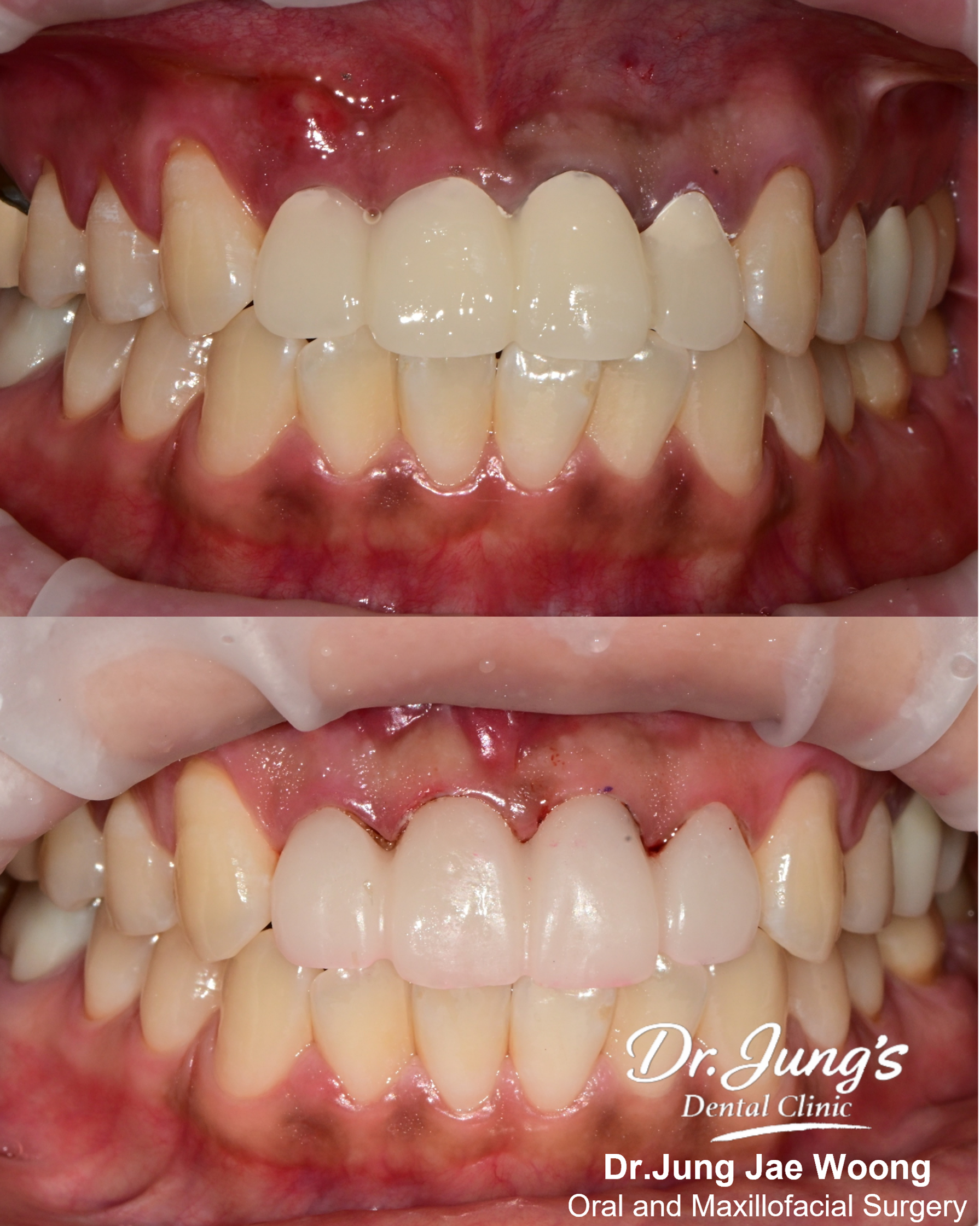 Gingival contouring