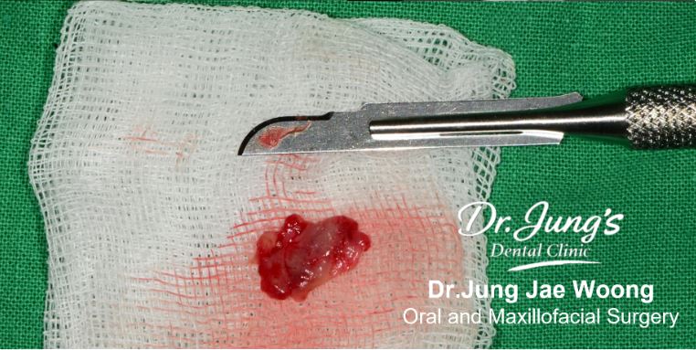 Cyst enucleation