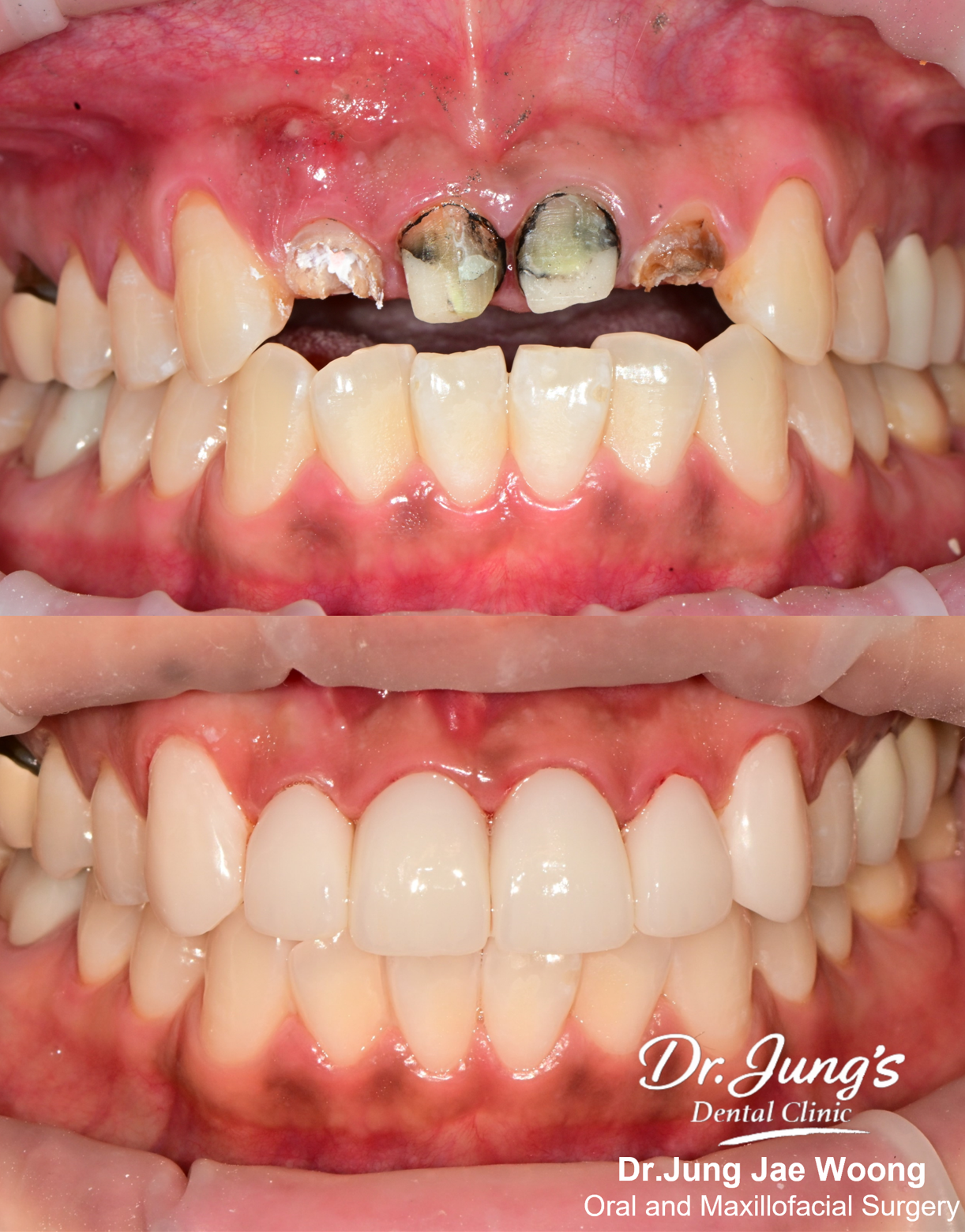 Tooth preservation before and after Dr. Jung's Jeju