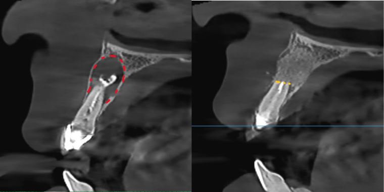 Cyst CT before after