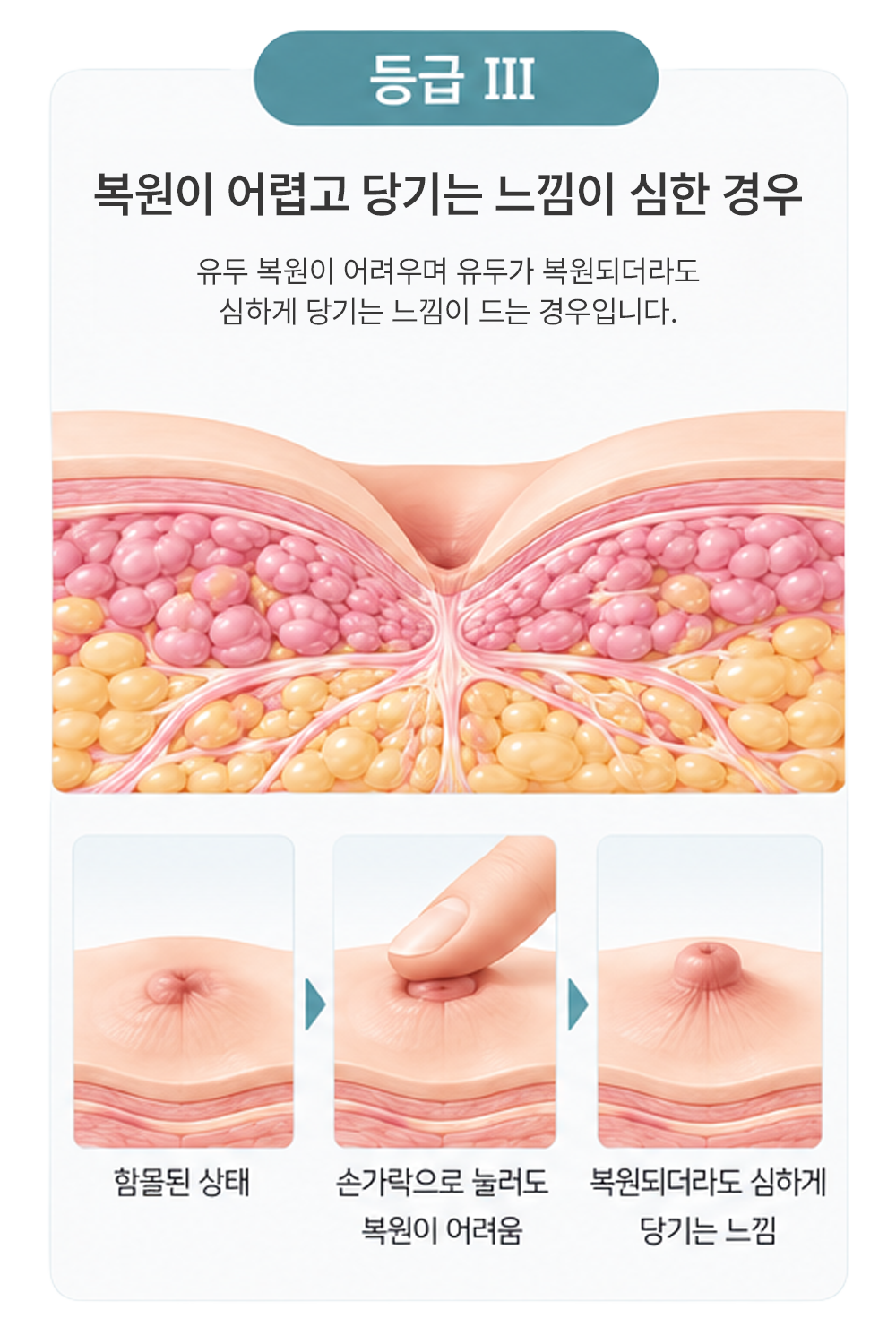 함몰 유두 등급 구분 3