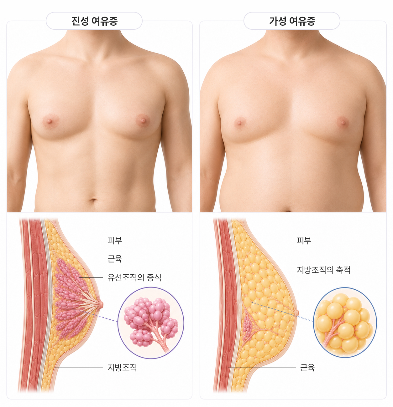 남성 여유증 종류 2가지