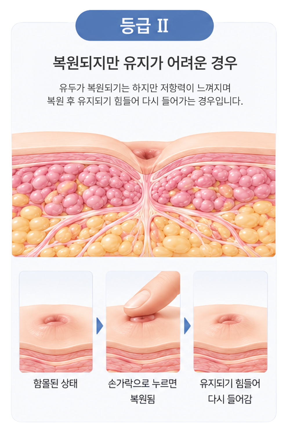 함몰 유두 등급 구분 2