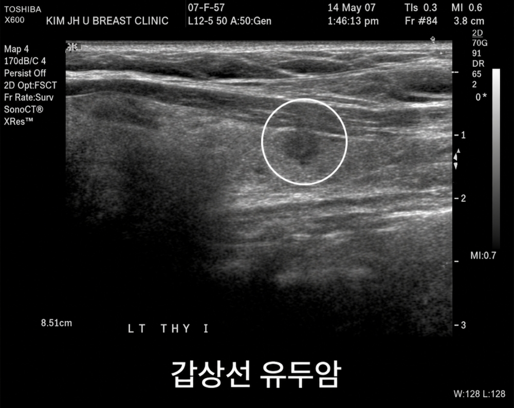 갑상선 유두암