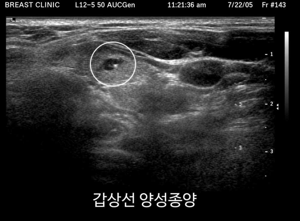 갑상선 양성종양
