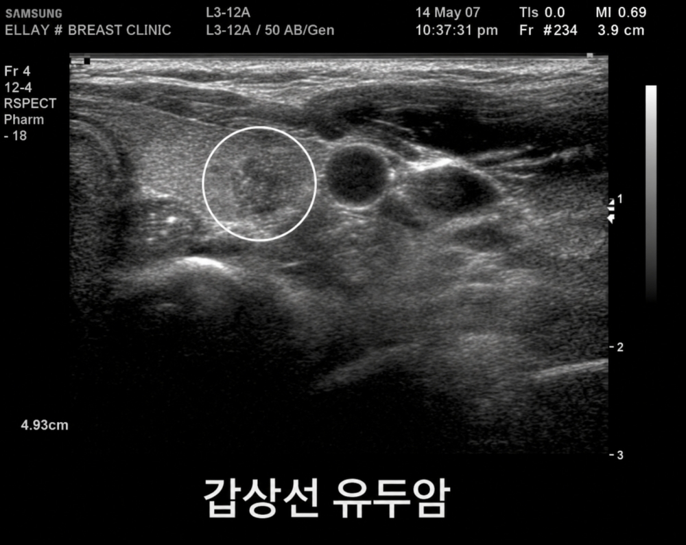 갑상선 유두암
