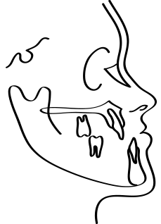 <p style="line-height: 2;"><span style="font-size: 16px;">아래턱의 과성장</span></p>