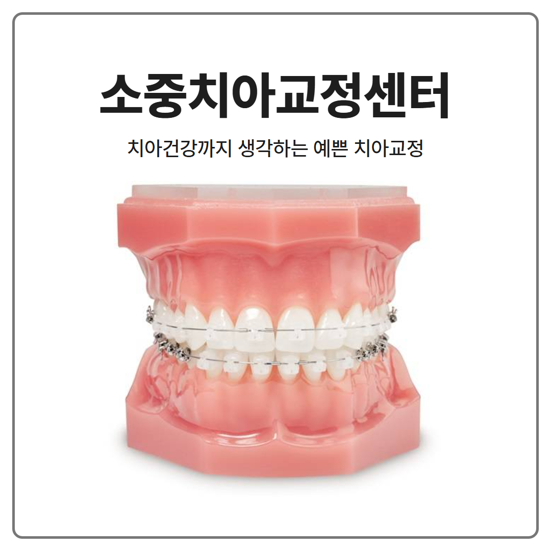 송파구 문정동 교정치과 투명교정 설측교정장치