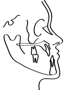 <p style="line-height: 2;"><span style="font-size: 16px;">위턱의 열성장</span></p>