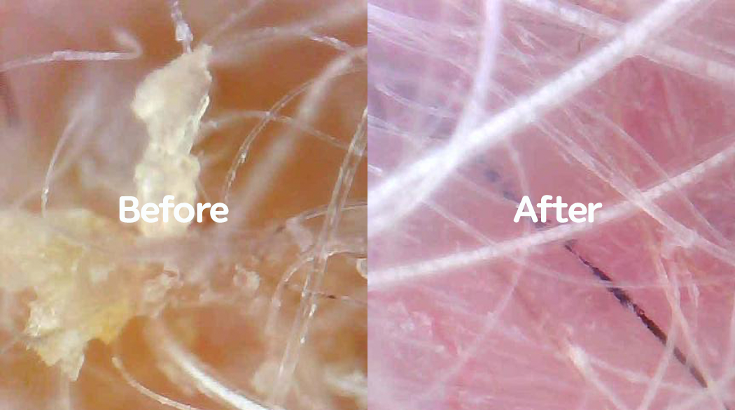 피부 진단 Before & After
