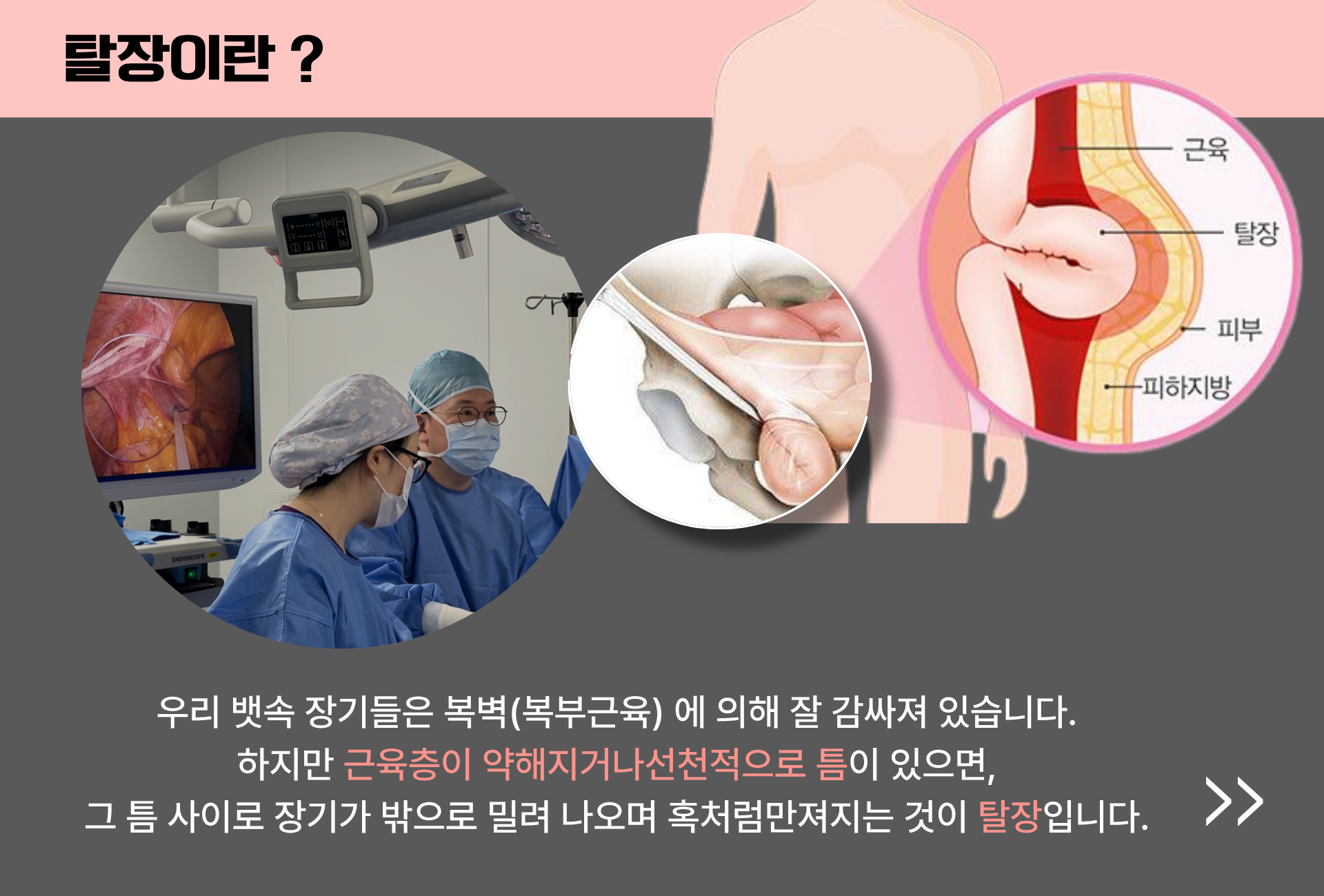 탈장이란 무엇인가요 우리 뱃속장기들은 복벽에 의해 잘 감싸져 있습니다. 하지만 근육층이 약해지거나 선천적으로 틈이 있으면, 그 틈사이로 장기가 밖으로 밀려나오면 혹처럼 만져지는것이 탈장입니다 