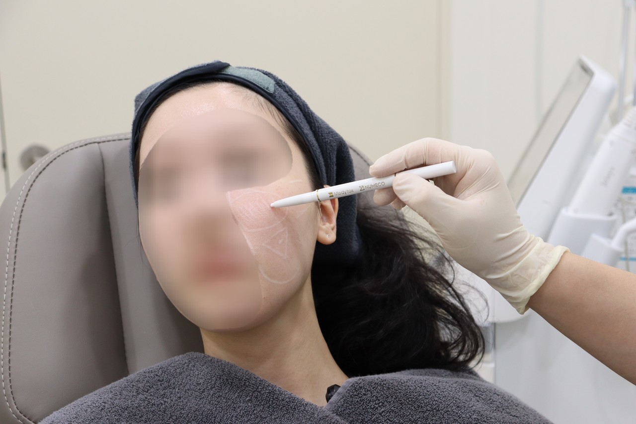 대전여드름피부과 시술 전 피부 상태를 확인하며 부위를 디자인하는 사진