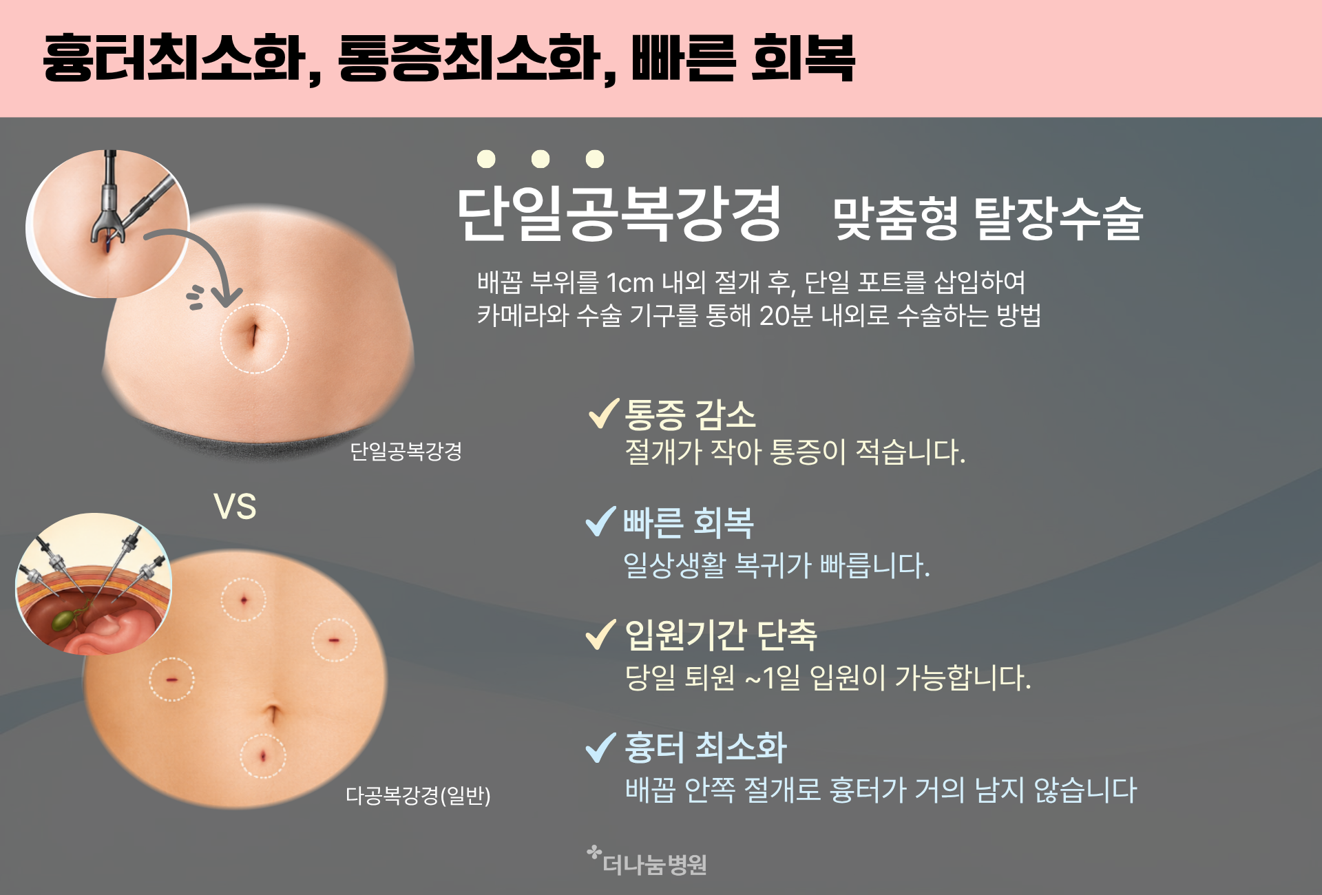 단일공복강경 맞춤형탈장수술 통증감소 빠른회복 입원기간단축 흉터최소화 