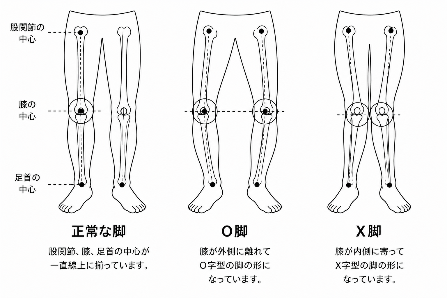 O脚 X脚