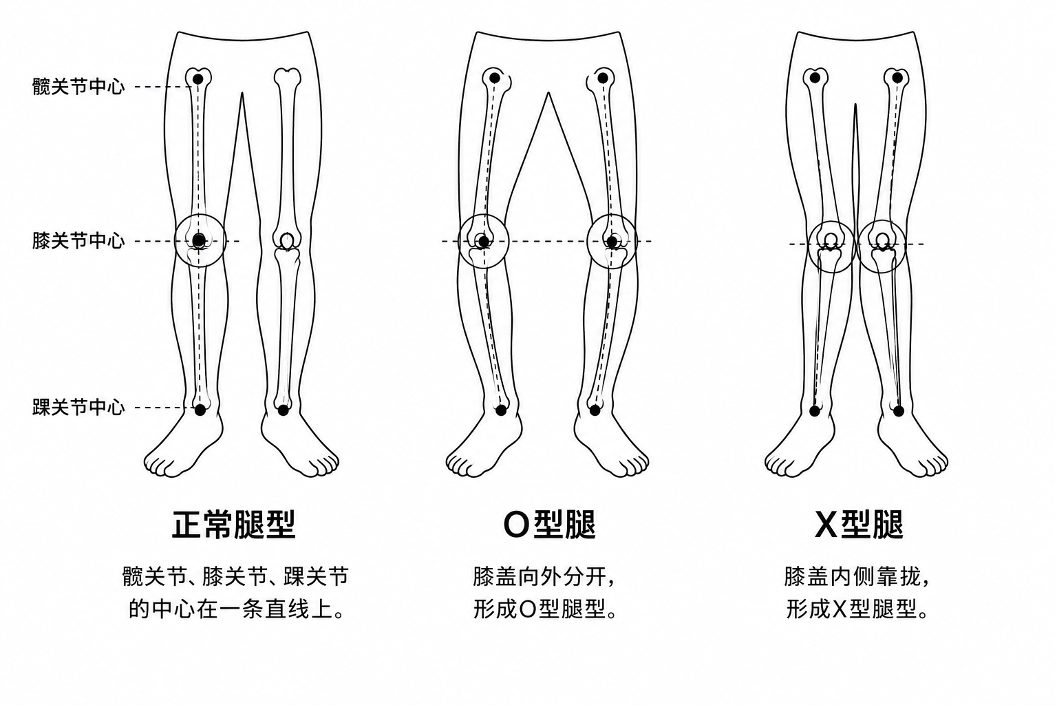 O型腿 X型腿