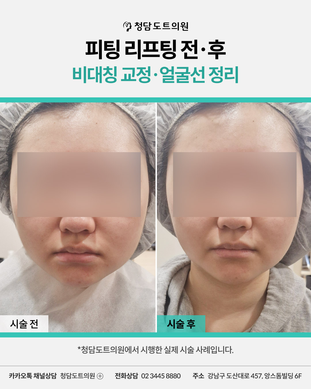 청담도트의원 피팅 리프팅 시술 전후