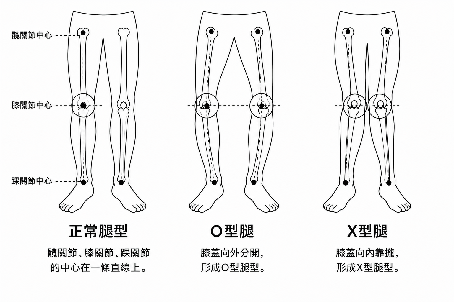 O型腿 X型腿
