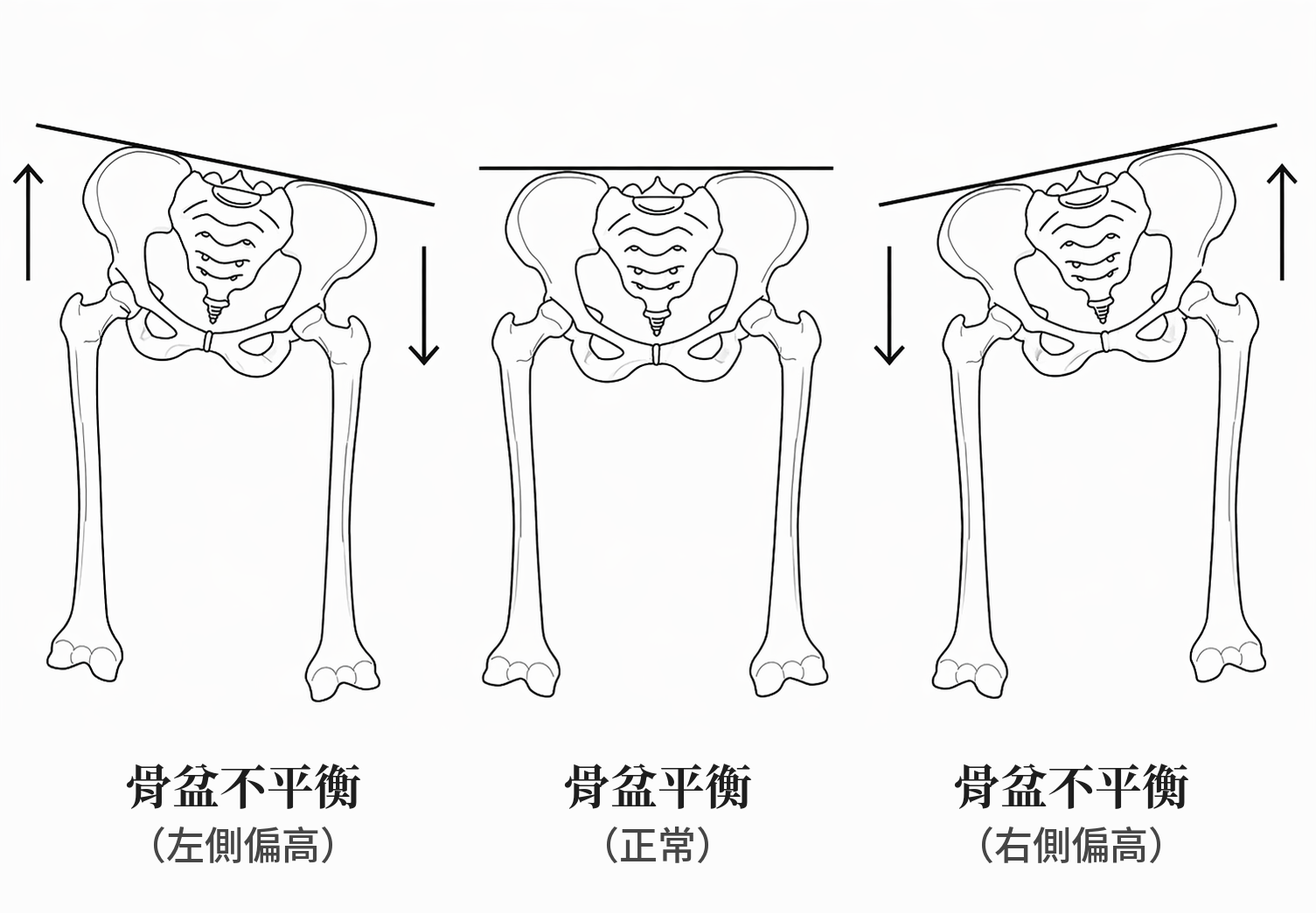 骨盆平衡